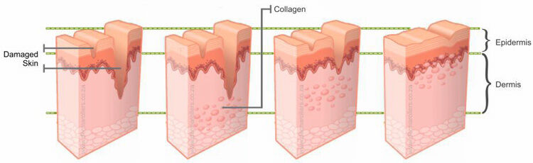 Derma Roller